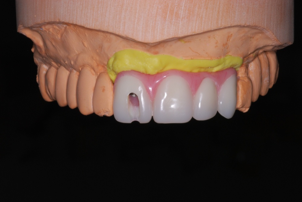How to Fabricate a Screw-retained Implant Temporary (6/6)