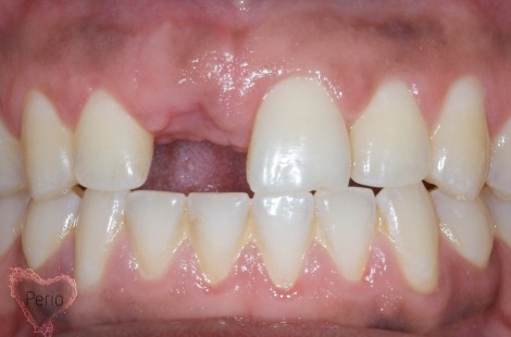 dental implant houston tx