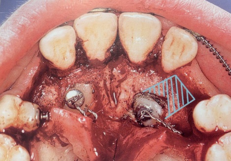 Palatal Approach Canine Exposure